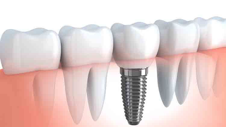 5 tipos de dispositivos de prótesis dental